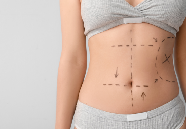 Viac než liposukcia: Liposkulptúra formuje telo a opticky zvýrazňuje svaly